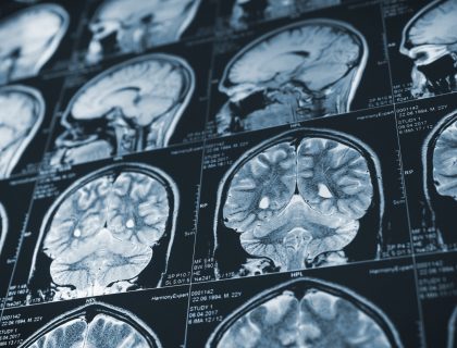 DELIRIUM OR ACUTE ENCEPHALOPATHY? CLEARING UP COMMON CODING CONFUSION